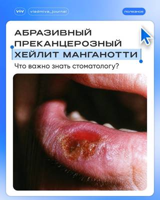 Хейлит Манганотти: тихая эрозия, требующая онконастороженности.